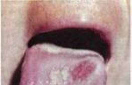 Гонорея — фото симптомов заболевания у мужчин и женщин Может ли быть гонорея во рту