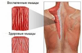 Почему болят мышцы спины?